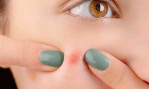 Почему появляются прыщи на лице перед месячными? Узнайте причины и решения