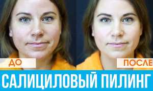 Салициловый пилинг для лица: виды, как проводится процедура и его преимущества