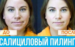 Салициловый пилинг для лица: виды, как проводится процедура и его преимущества