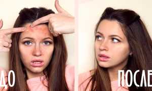 Прыщи на лбу как маркер проблем с внутренними органами: причины и решения