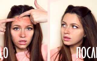 Прыщи на лбу как маркер проблем с внутренними органами: причины и решения