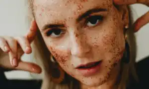 Узловатая эритема кожи и её симптомы – какое лечение эффективно для здоровья