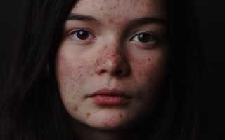 Почему нельзя давить прыщи на лице и теле, и так ли это на самом деле