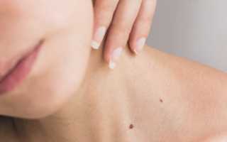 Можно ли выдавливать прыщи самостоятельно? Мнение дерматологов