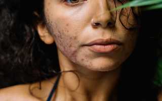 Ненавистные прыщи на щеках у женщин: как избавиться от акне навсегда и сохранить здоровье кожи