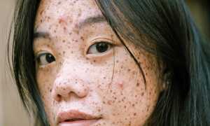 Популярные причины появления прыщей на лице и их последствия