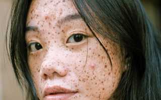 Популярные причины появления прыщей на лице и их последствия