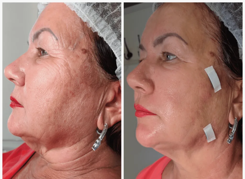 Подтяжка лица нитями коги до и после