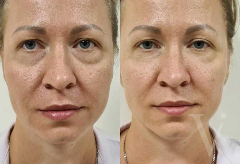 сферогель до и после