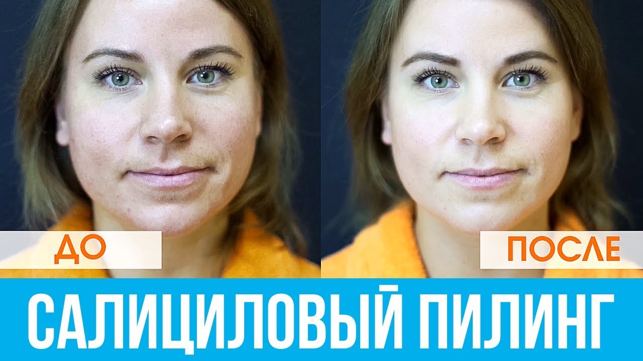 Салициловый пилинг