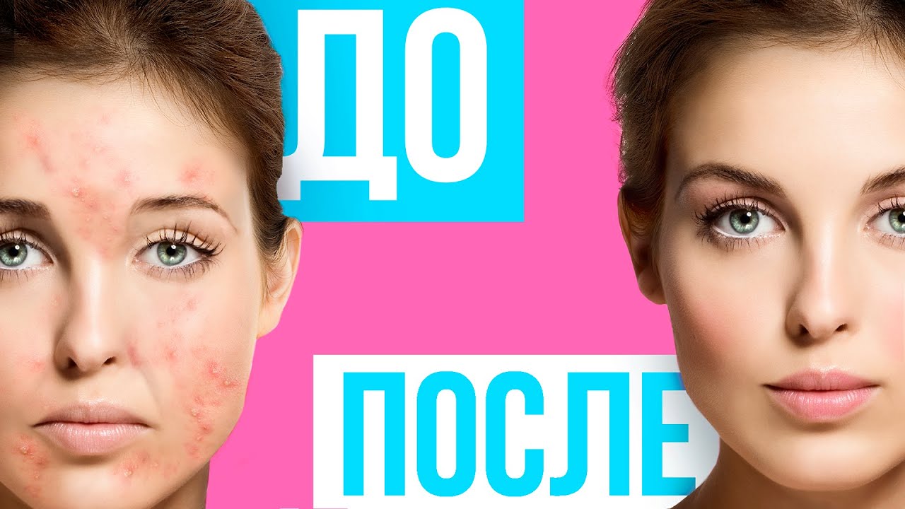 Как предотвратить появление прыщей?