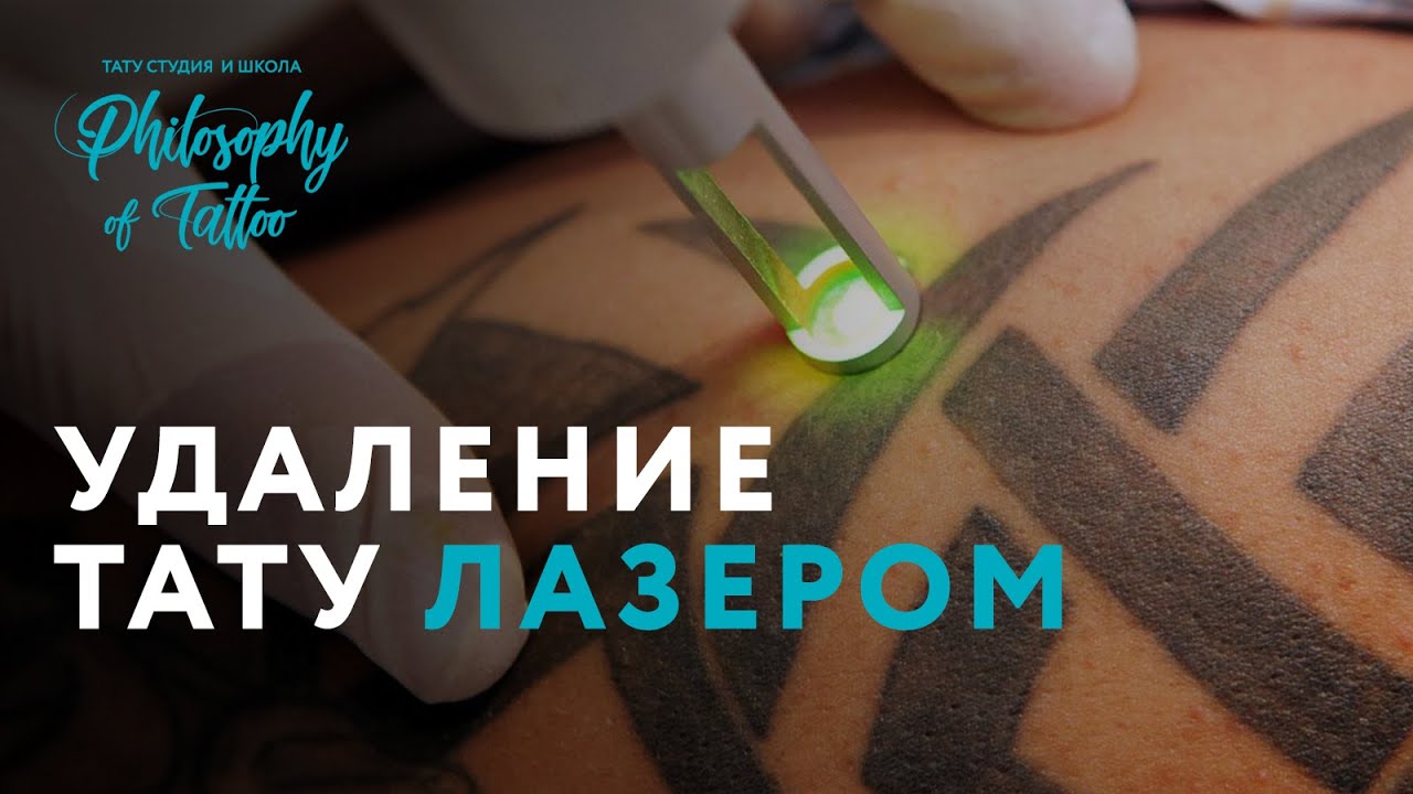Удаление татуировки лазером